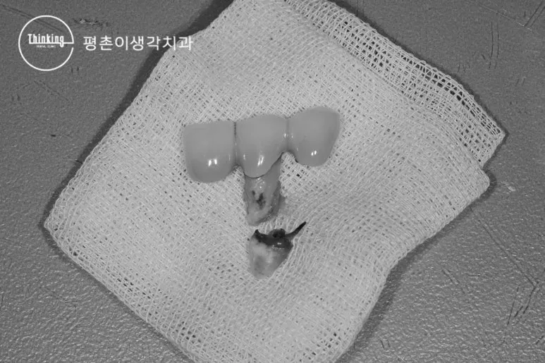 제거한 기존 보철물과 함께 뽑아낸 치아 뿌리