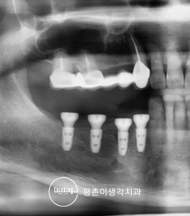 임플란트 고정체와 주변 잇몸뼈가 붙은 상태를 확인한 치유 후 방사선 사진