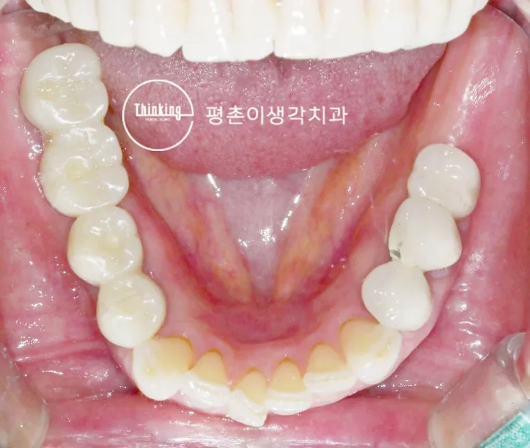 최종 보철물까지 마친 아래턱 교합면 구강 사진