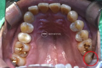 위턱 씹는 면 전체 구강 사진, 왼쪽 맨 뒤 어금니의 금 인레이가 빠진 자리를 붉은 원으로 표시