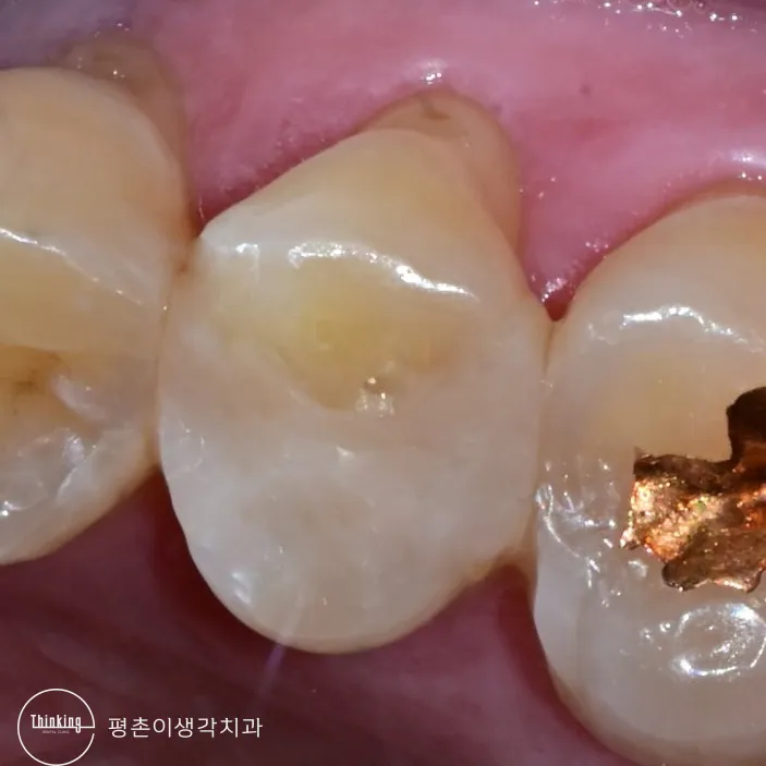 충치를 제거하고 새 인레이 제작을 위해 본을 뜰 수 있도록 다듬은 작은어금니