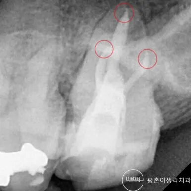 신경치료를 마치고 뿌리관을 충전한 상태를 붉은 원으로 표시한 치근단 방사선 사진