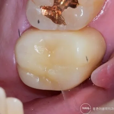 신경치료를 마친 어금니에 크라운을 씌워 수복한 모습