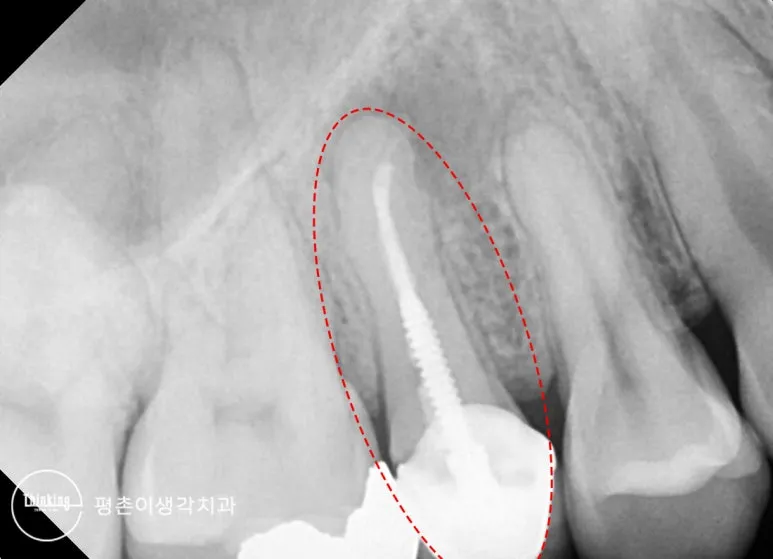 나사 모양 금속 포스트가 박힌 뿌리와 주변 염증 음영을 빨간 점선으로 표시한 재신경치료 전 방사선 사진