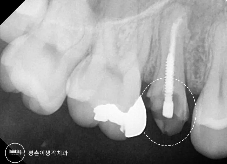 위 어금니 뿌리에 박힌 나사 모양 금속 포스트와 그 주변 부위를 흰색 점선으로 표시한 치근단 방사선 사진
