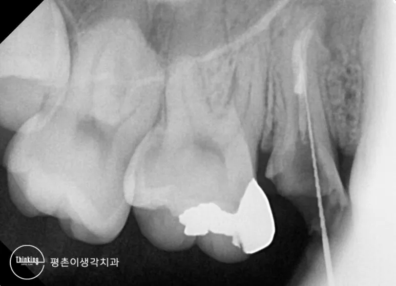 금속 포스트와 기존 근관 충전재를 제거해 근관이 비어 보이는 위 어금니 재신경치료 중 치근단 방사선 사진