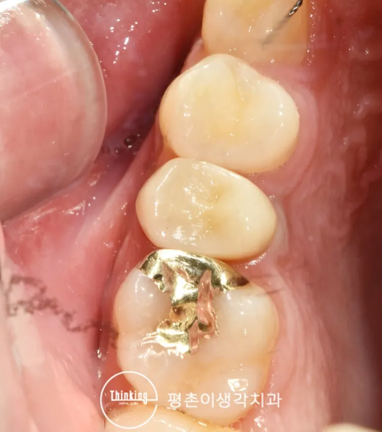 삭제했던 지대치에 자연치 색 크라운을 씌워 마무리하고 옆 치아에 골드 수복물이 보이는 교합면 구내 사진