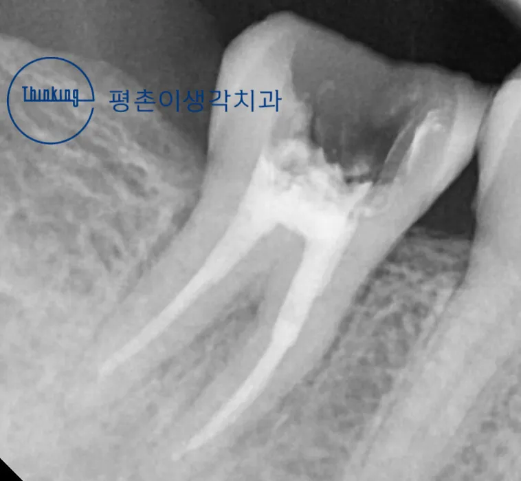 여러 개의 근관이 충전재로 빈틈없이 채워진 모습이 보이는 신경치료 직후 어금니 치근단 방사선 사진