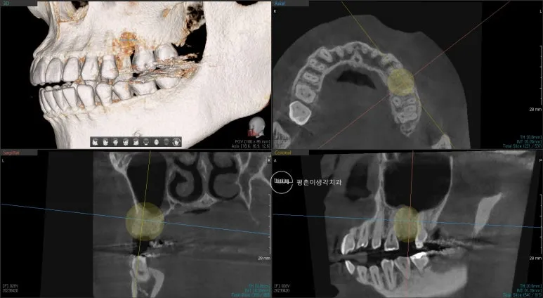 염증 부위와 임플란트 식립 위치를 함께 계획한 CT 영상
