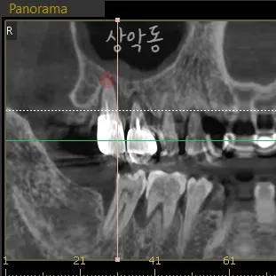 상악동 위치를 표시한 CBCT 파노라마 단면