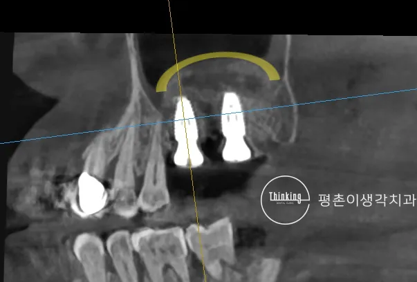 상악동 바닥을 들어 올린 범위를 노란 곡선으로 표시한 CBCT 단면