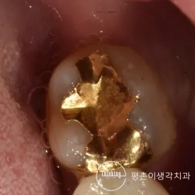 오래 사용해 가장자리가 들뜬 어금니 금 인레이의 씹는 면 근접 사진