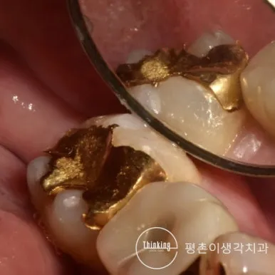 구강거울로 함께 비춰 본 왼쪽 아래 어금니 두 곳의 금 인레이