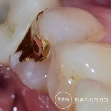 금 인레이와 자연치아가 만나는 경계에 틈과 변색이 보이는 어금니 근접 사진
