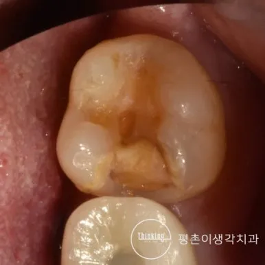 금 인레이가 빠져 씹는 면이 파인 채로 남은 어금니