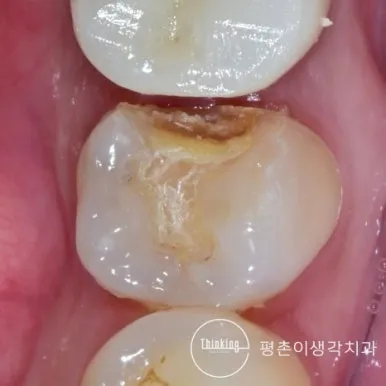 인레이가 빠진 자리에 파인 홈이 그대로 드러난 어금니 씹는 면