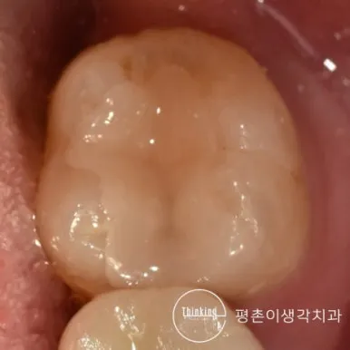 치아색 하이브리드 인레이로 수복을 마친 어금니 씹는 면