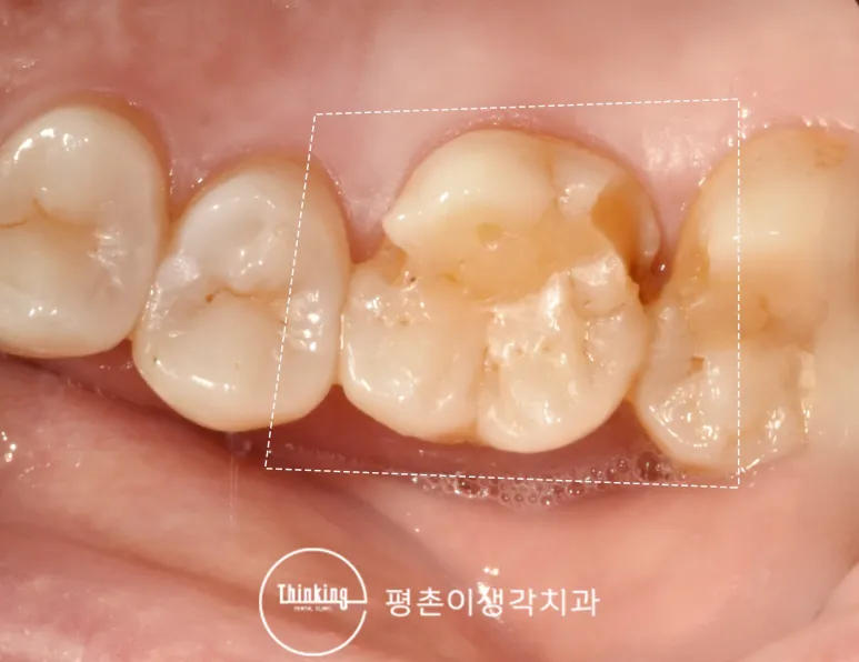 어금니 씹는 면 일부가 떨어져 나간 부위를 흰 점선으로 표시한 구강 사진