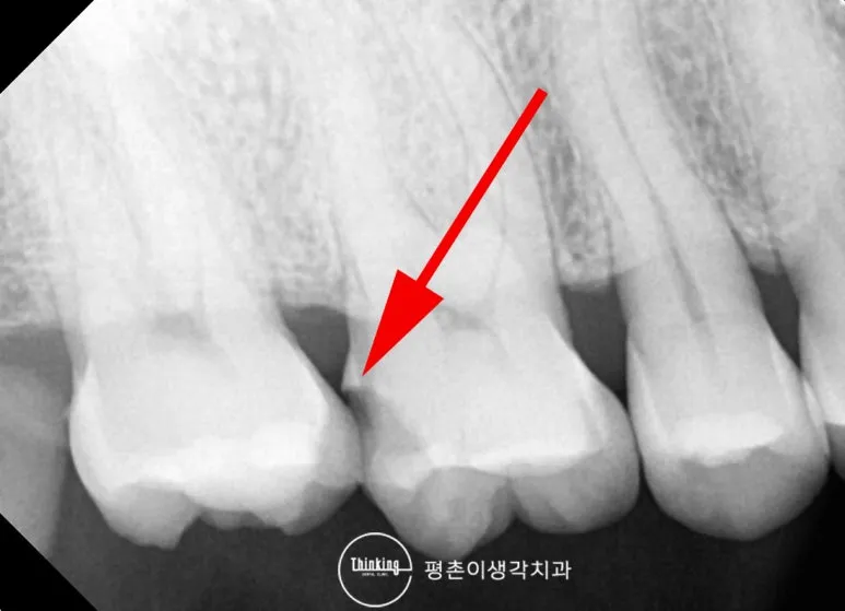 치근단 방사선 사진, 어금니 충치 부위를 붉은 화살표로 표시
