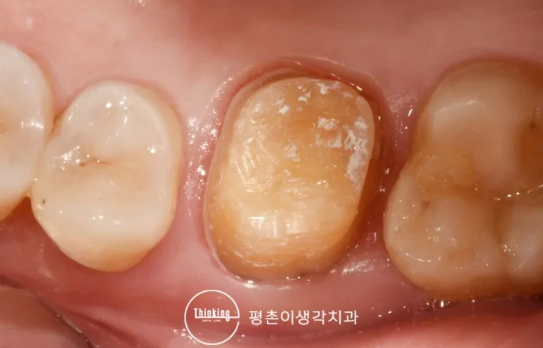 충치를 제거하고 크라운이 올라갈 형태로 다듬은 어금니 지대치