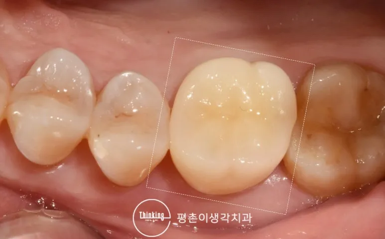 크라운을 씌워 수복을 마친 어금니를 흰 점선으로 표시한 구강 사진