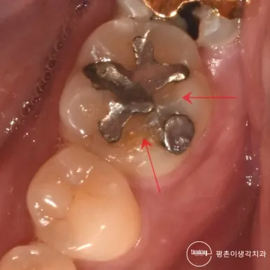 오래된 은색 아말감이 채워진 어금니 씹는 면, 주변의 어두운 부위를 붉은 화살표로 표시