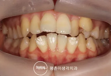 치료 전 정면 구강 사진, 앞니가 서로 겹치고 틀어진 심한 총생