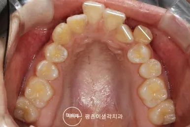 치료 전 위턱을 씹는 면에서 본 사진, 앞니가 배열될 공간이 부족한 상태