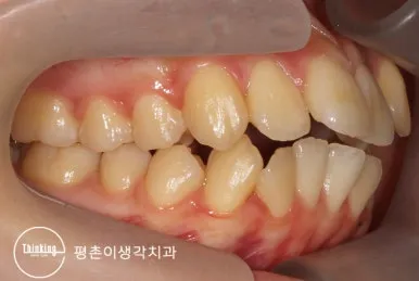 치료 전 오른쪽에서 본 총생과 앞니 돌출