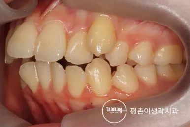 치료 전 왼쪽에서 본 총생과 앞니 돌출