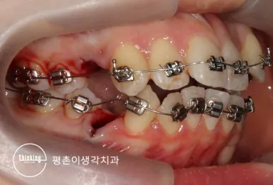 메탈 브라켓을 붙이고 오른쪽 소구치를 발치한 직후의 측면 구강 사진