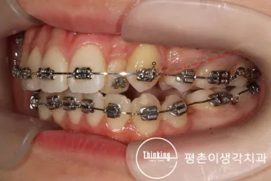 치료 중 왼쪽 발치 공간이 닫혀 가는 측면 구강 사진