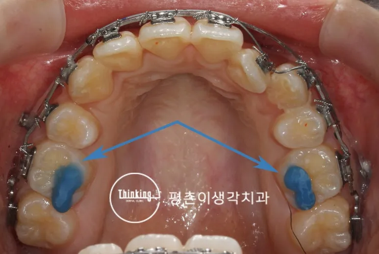 위턱 어금니 씹는 면에 올린 파란색 바이트 레진을 화살표로 표시한 사진