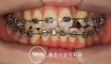 배열이 크게 개선된 치료 중 정면 구강 사진