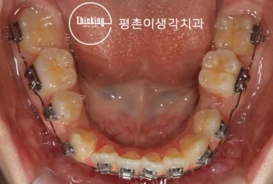 아래턱에 교정 장치를 부착한 상태를 씹는 면에서 본 사진