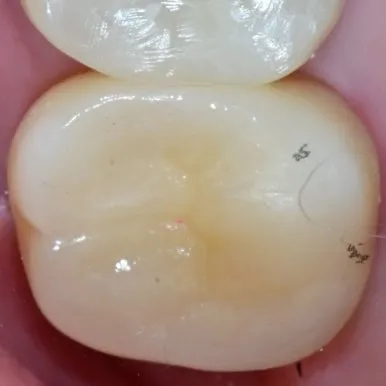 최종 크라운을 장착한 뒤 교합 확인을 위해 표시선을 그려 둔 어금니 교합면 확대 구내 사진