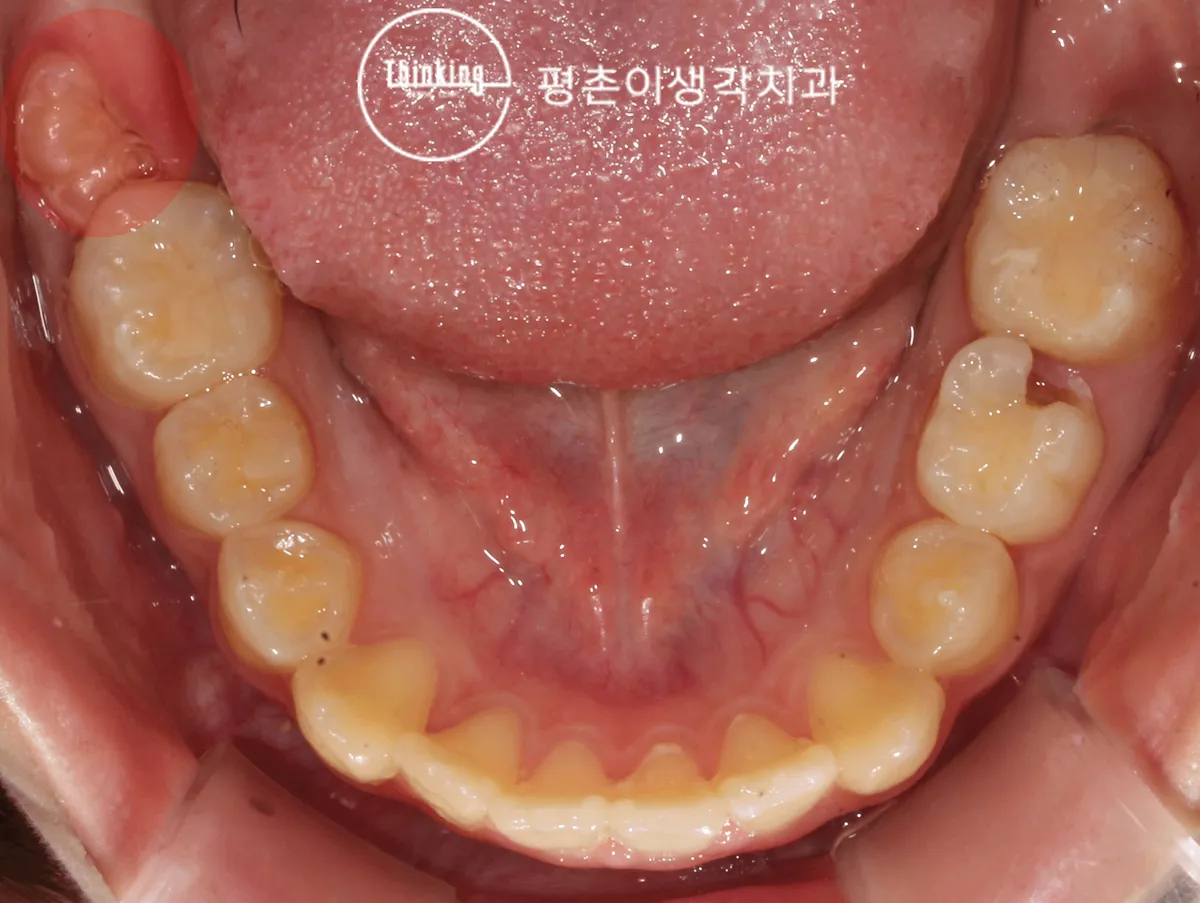 아래턱을 씹는 면에서 본 사진, 맹출하다 멈춘 어금니가 일부만 드러난 상태
