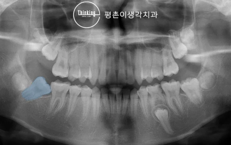 영구 어금니가 앞 유치에 걸려 있는 상태를 파란색으로 표시한 파노라마 방사선 사진