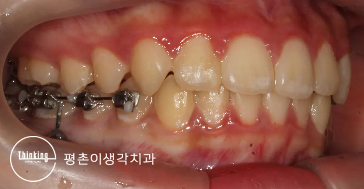문제가 되는 부위에만 브라켓을 붙인 측면 구강 사진
