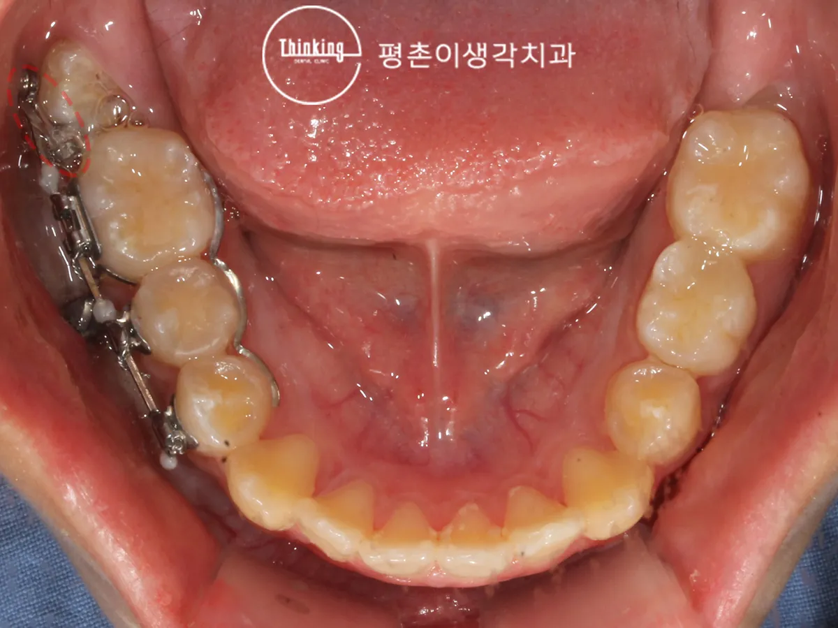 브라켓에 파워체인을 연결한 아래턱 교합면 사진