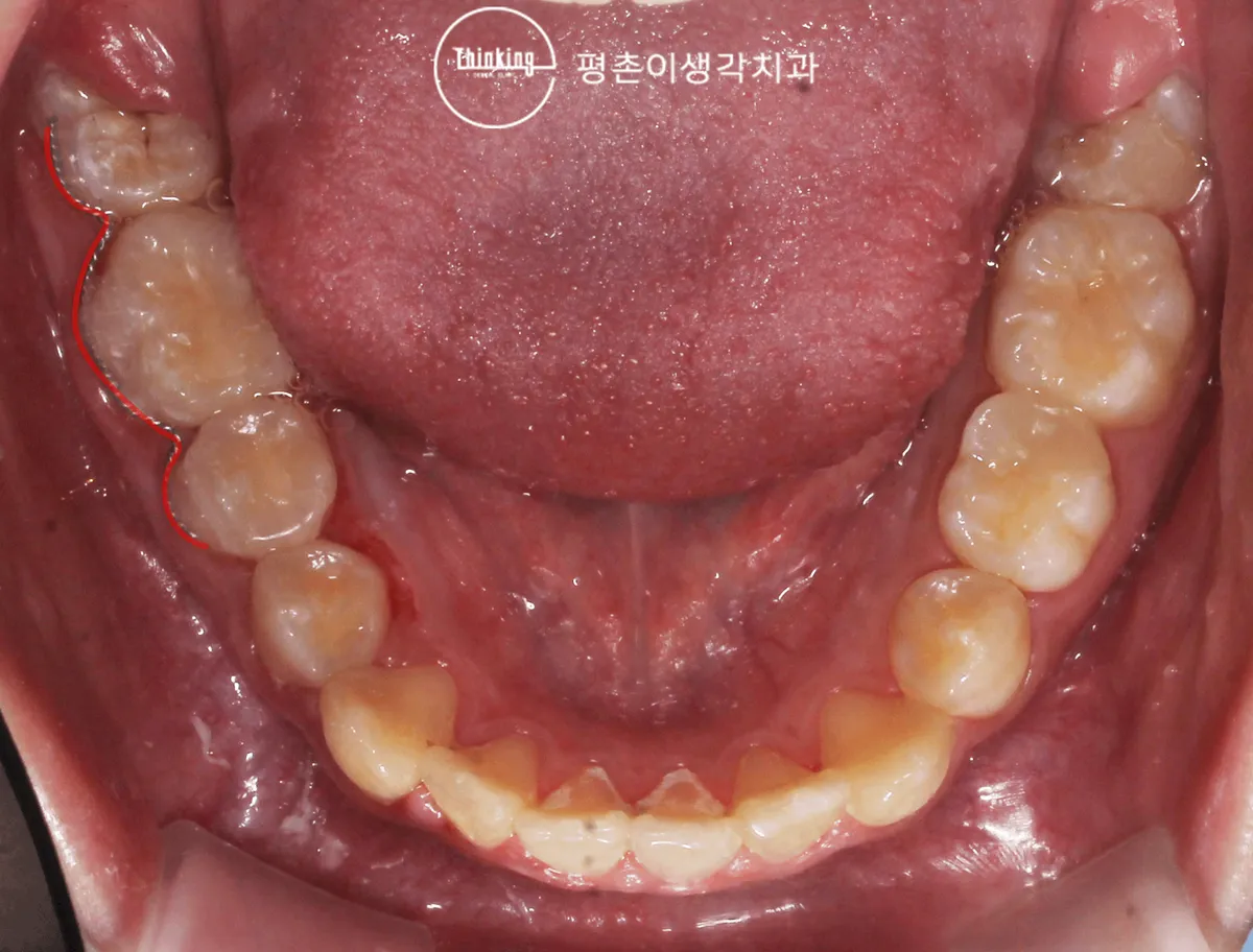견인 후 정상 위치로 올라온 어금니를 씹는 면에서 본 사진