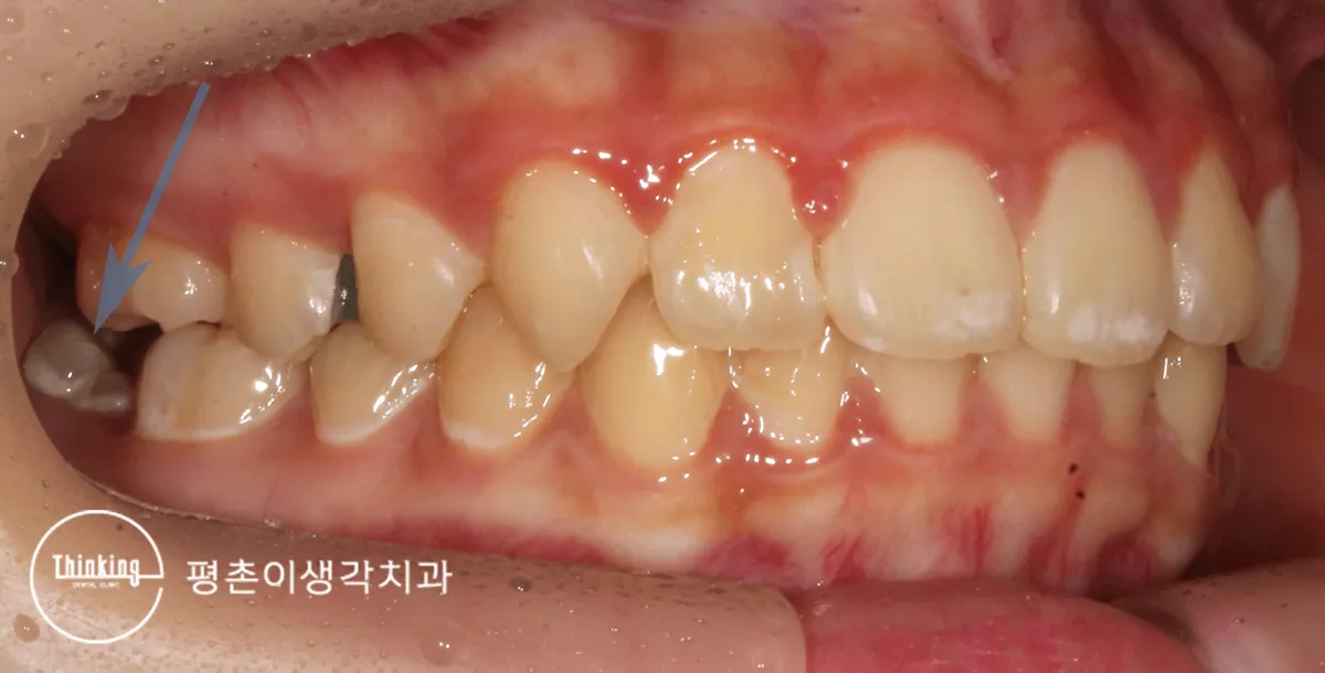 걸려 있던 영구 어금니의 맹출 상태를 측면에서 확인한 구강 사진