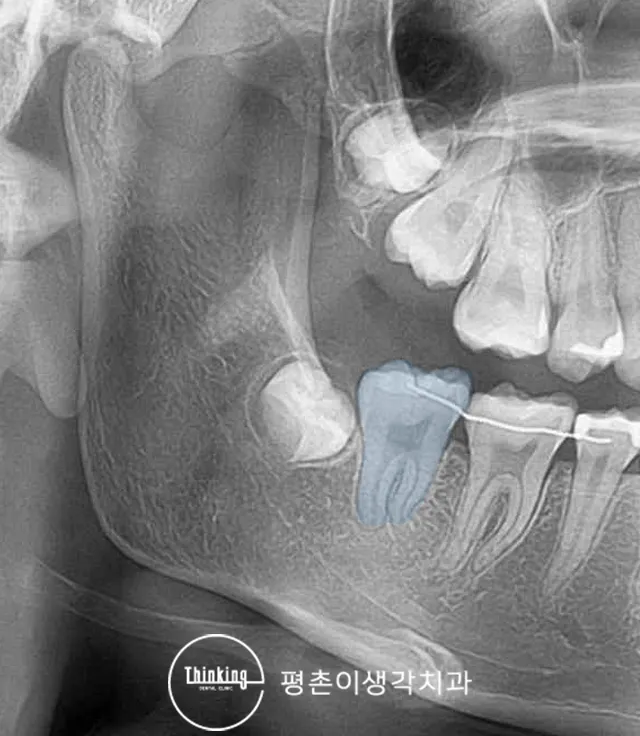 와이어로 걸린 어금니의 이동 공간을 확보한 상태를 촬영한 엑스레이
