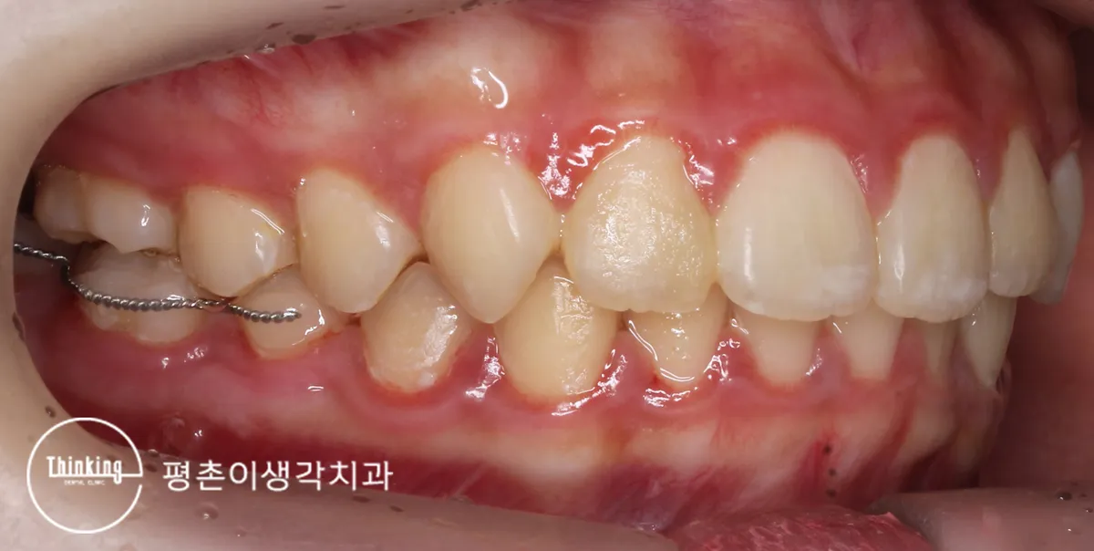 치료 후 씹는 높이까지 올라온 어금니의 측면 구강 사진